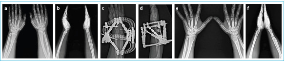 Computer-Assisted Circular External Fixator in the Treatment of Wrist and Forearm Deformities: Functional and Radiological Outcomes.