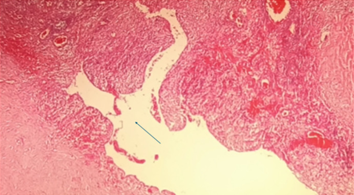 Isolated Hydatid Cyst of the Breast: A Rare Pseudotumor of the Breast.