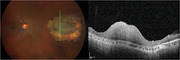 Retinoma: An overview.