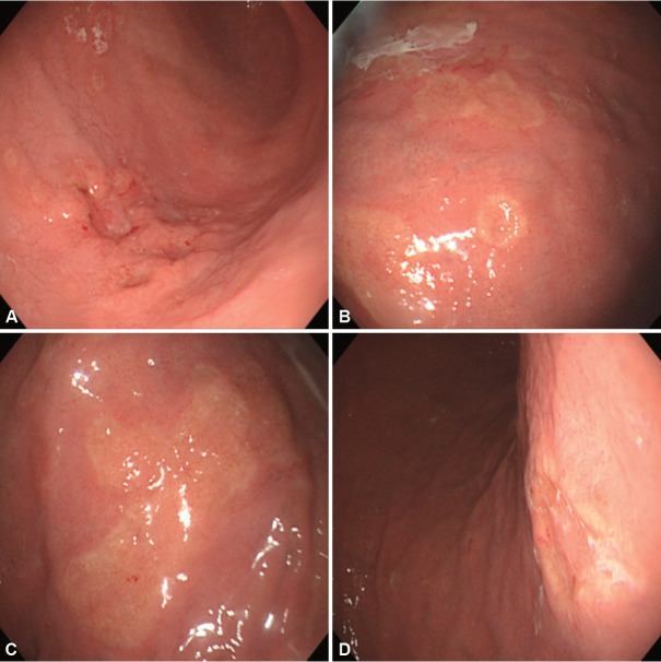 Gastric Ulcers Caused by Non-Helicobacter pylori Infections.