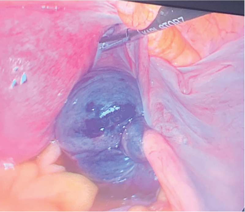 Adnexal Incarceration in a Posterior Pelvic Peritoneal Defect Associated with Ovarian Torsion: A Case Report.