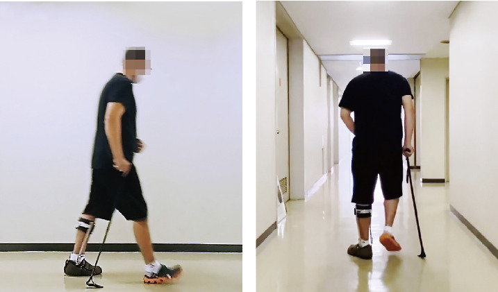 Effect of the Carbon-Curved Cane Use on Gait in Chronic Stroke-Induced Hemiplegia: A Prospective Single-Case Study.