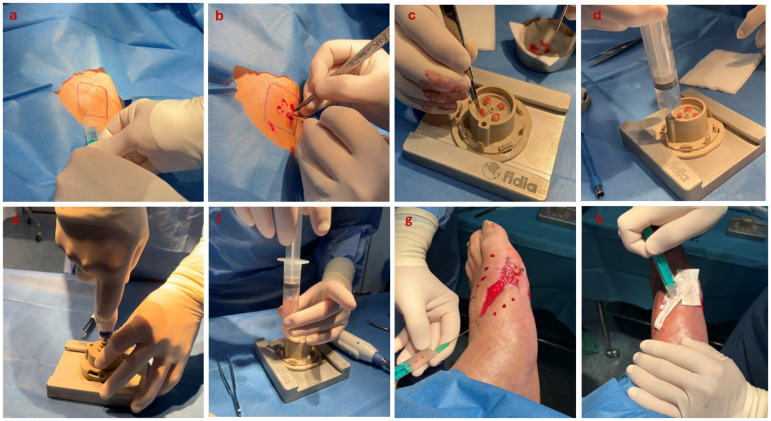 Skin Micro-Fragments for the Management of Diabetic Foot Ulcers: A Case Series.