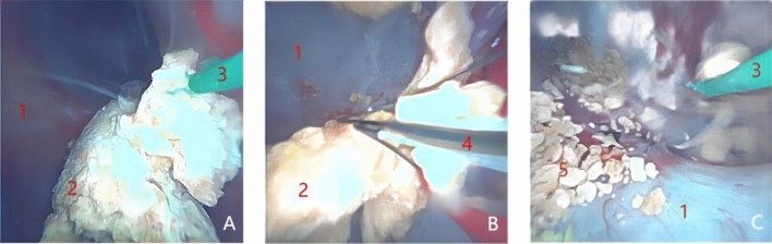 Analysis of the effectiveness and safety of 7.5 Fr ultra-thin flexible ureteroscope combined with a tip-flexible suctioning ureteral access sheath for the treatment of kidney stones.