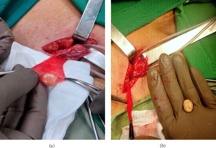 A Case Report of Inguinal Hernia Sac Lithiasis.