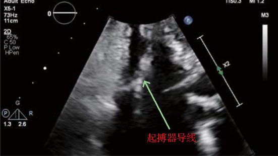 [Research of tricuspid regurgitation associated with cardiac implantable electronic devices].