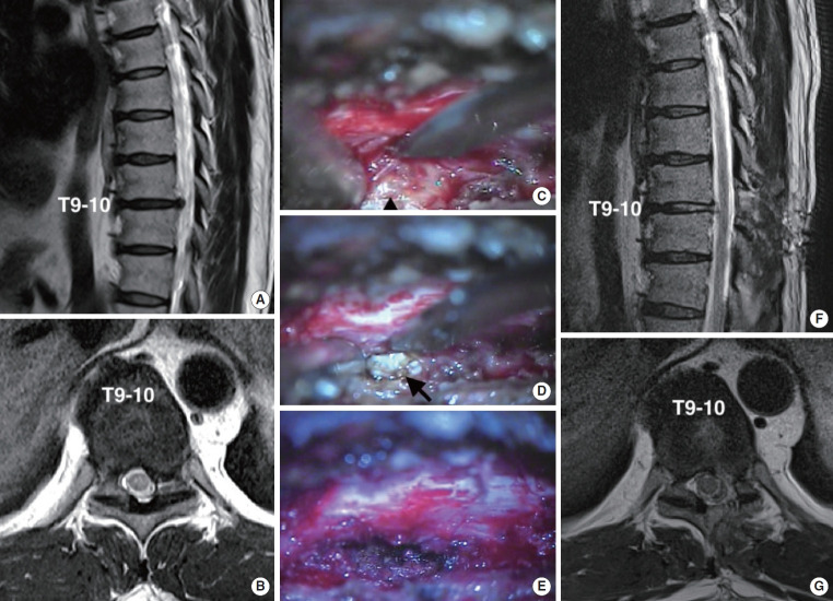 Transforaminal Endoscopic Thoracic Discectomy Is More Cost-Effective Than Microdiscectomy for Symptomatic Disc Herniations.