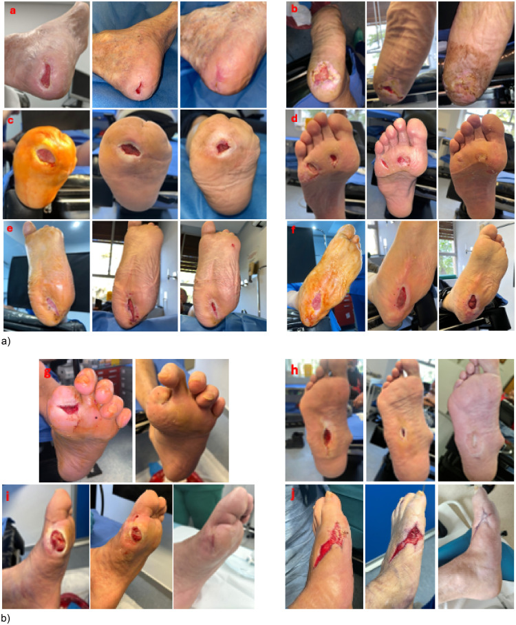 Skin Micro-Fragments for the Management of Diabetic Foot Ulcers: A Case Series.