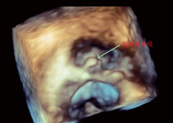 [Research of tricuspid regurgitation associated with cardiac implantable electronic devices].