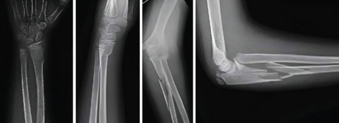 Type 1 Monteggia Equivalent Fracture with Ipsilateral Distal Radius Fracture: A Case Report.