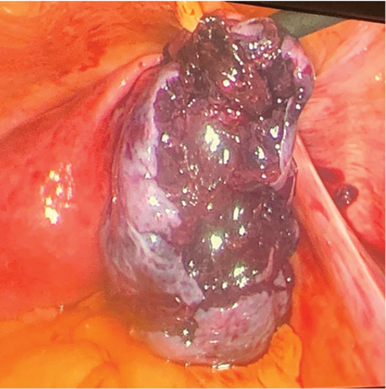 Adnexal Incarceration in a Posterior Pelvic Peritoneal Defect Associated with Ovarian Torsion: A Case Report.