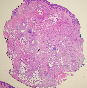 A Case of Highly Recurrent DFSP: Treatment Dilemmas and Considerations.