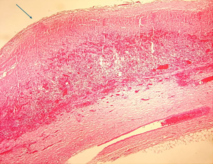 Isolated Hydatid Cyst of the Breast: A Rare Pseudotumor of the Breast.