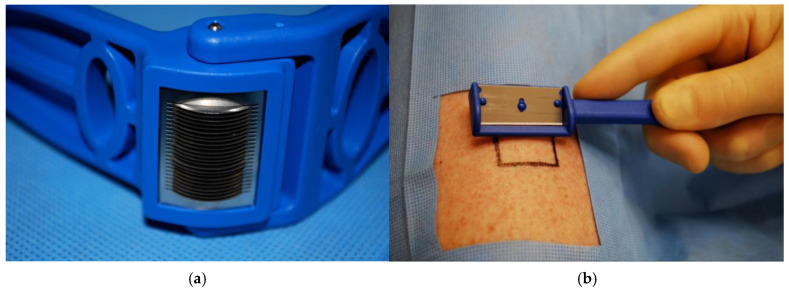 Novel Techniques in Fractional Skin Replacement.