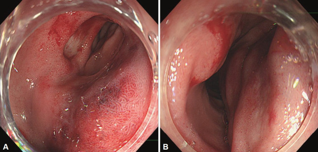 A Rare Complication of Endoscopic Epinephrine Injection Therapy for Duodenal Ulcer Bleeding.