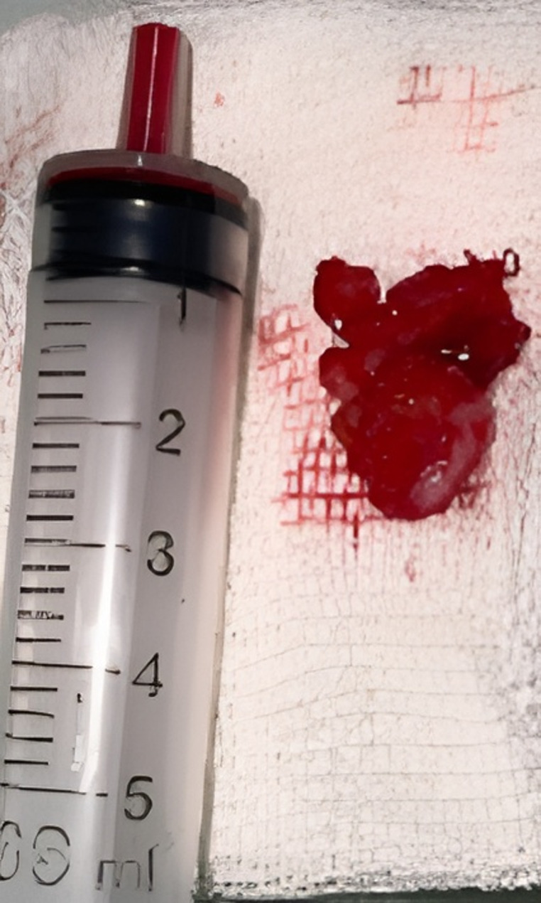 Invasive bony destructive orbital aspergillosis in an immunocompetent child: a case report.