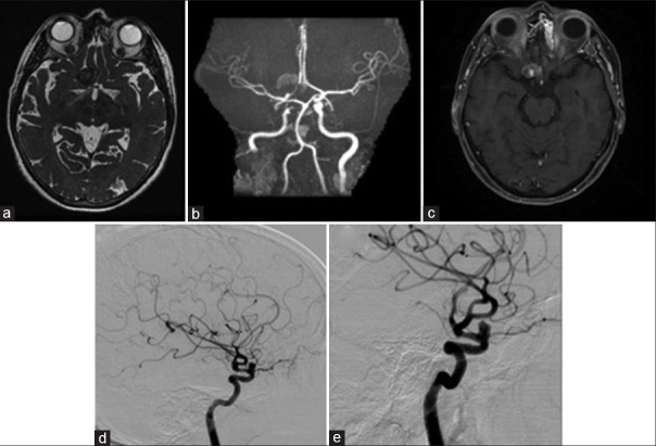 Delayed destabilization and rupture of a giant anterior circulation aneurysm following flow-diverter placement: A case report.