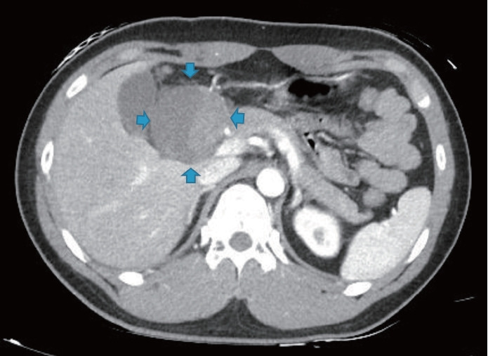 A Rare Complication of Endoscopic Epinephrine Injection Therapy for Duodenal Ulcer Bleeding.