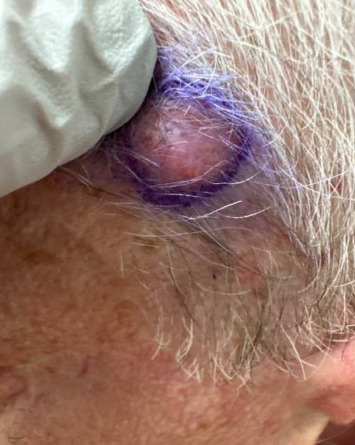 A Case of Highly Recurrent DFSP: Treatment Dilemmas and Considerations.