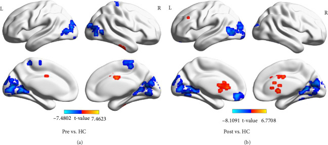 Exploring the Effects of Action Observation Therapy on Swallowing Disorders in Stroke: A Functional Connectivity-Based fMRI Study.