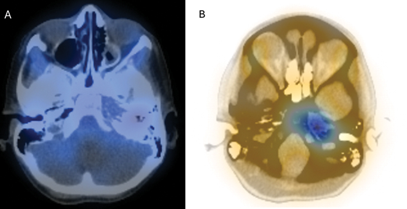 Skull Base Rhabdomyosarcoma Mimicking Osteomyelitis in a Pediatric Patient.