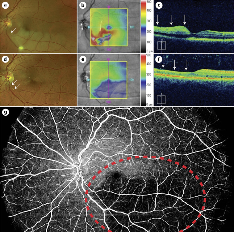 Fovea Sparing Branch Retinal Artery Occlusions Imaged with Optical Coherence Tomography Angiography: Two Case Reports.