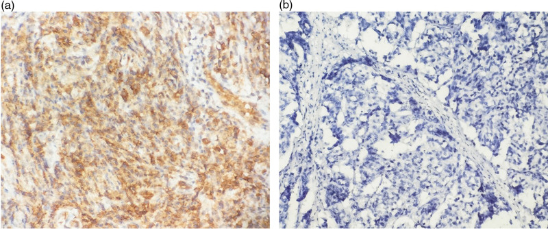 High CXCL8 expression predicting poor prognosis in triple-negative breast cancer.