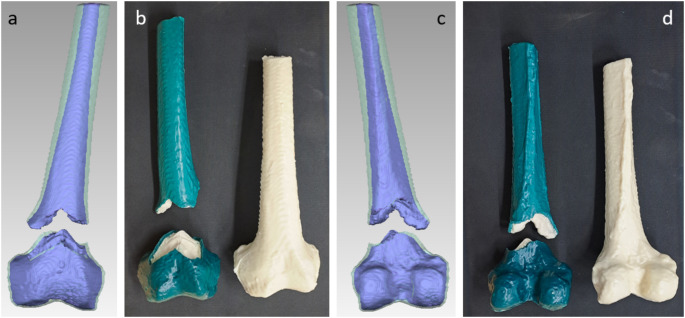 Impact of fracture morphology on the biomechanical stability of osteosynthetic fixation.