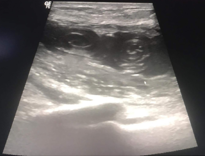 Isolated Hydatid Cyst of the Breast: A Rare Pseudotumor of the Breast.