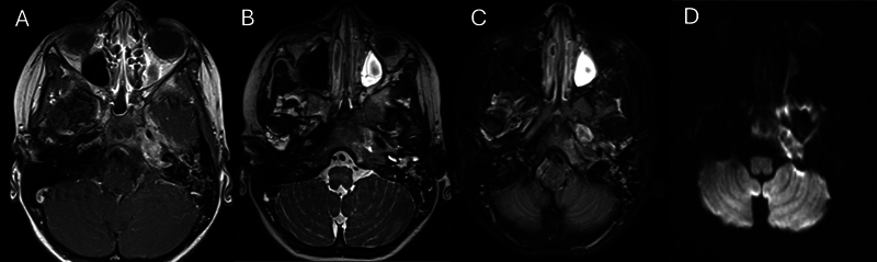 Skull Base Rhabdomyosarcoma Mimicking Osteomyelitis in a Pediatric Patient.