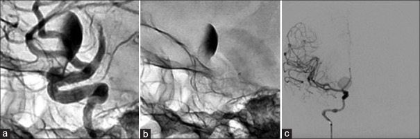 Delayed destabilization and rupture of a giant anterior circulation aneurysm following flow-diverter placement: A case report.