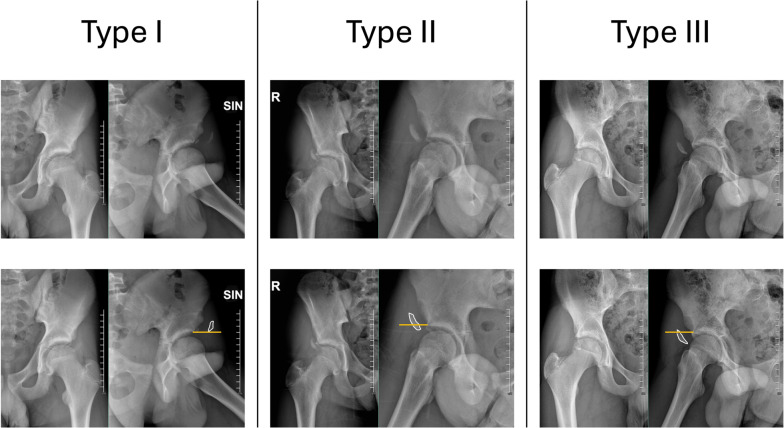 Endoscopic-assisted percutaneous fixation for displaced anterior inferior iliac spine avulsion fractures: a prospective cohort study.