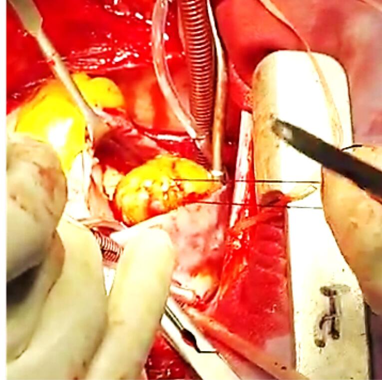 Relation of giant right atrial mass and thrombocytopenia; Recovery with surgery.