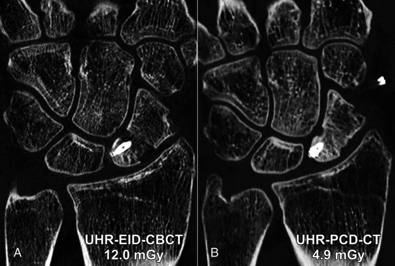 Photon-Counting Detector CT Applications in Musculoskeletal Radiology.