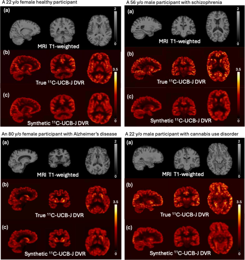 Generating synthetic brain PET images of synaptic density based on MR T1 images using deep learning.