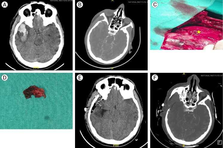 Traumatic middle meningeal artery pseudoaneurysm: Case report and review of literature.