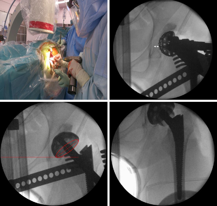 Accuracy of Implant Positioning in Total Hip Arthroplasty via a Supine Direct Anterior Approach Using Fluoroscopy.