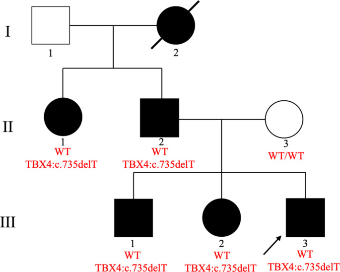 A novel frameshift TBX4 variant in a family with ischio-coxo-podo-patellar syndrome and variable severity.