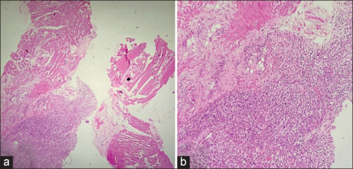 A Case Report of Metastatic Primary Thyroid Sarcoma Evaluated by <sup>18</sup>F-FDG PET/CT.
