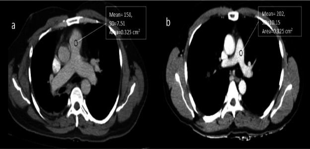 Low Dose Contrast Enhanced CT Thorax Protocol: Comparison of Low Kilovoltage, Low Contrast Volume Using Iterative Reconstruction Technique with Standard Protocol.