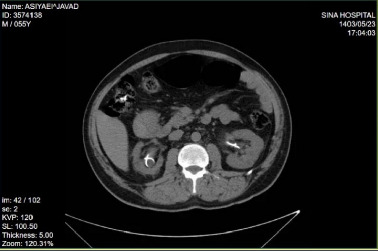 Knotted and Encrusted Double J Stent: A Rare Complication Managed With Advanced Endoscopic Techniques.
