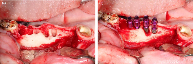 Influence of buccal bone lamella defects on hard and soft tissues with submerged and non-submerged healing in immediate implants - an experimental study in minipigs.