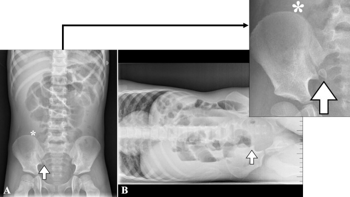 [Abdominal pain and inconclusive ultrasound: a CT scan may not always be the best next step]