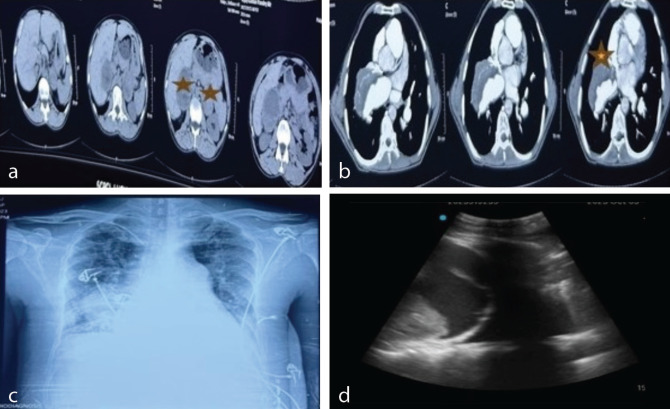 Challenging Perioperative Management of a MEN2A Syndrome Patient Complicated by Eisenmenger Syndrome.