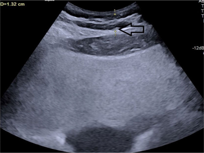 Ultrasonography-based prediction of carotid artery atherosclerosis using multiple abdominal fat indices.
