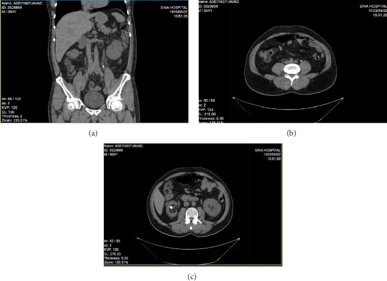 Knotted and Encrusted Double J Stent: A Rare Complication Managed With Advanced Endoscopic Techniques.