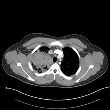 Severe Pulmonary Blastomycosis in a Young Adult: Probable Role of E-Cigarette Use in Immunosuppression.
