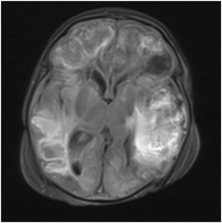 <i>Salmonella</i> meningitis bacteremia in two-week neonate: A rare and devastating disease.
