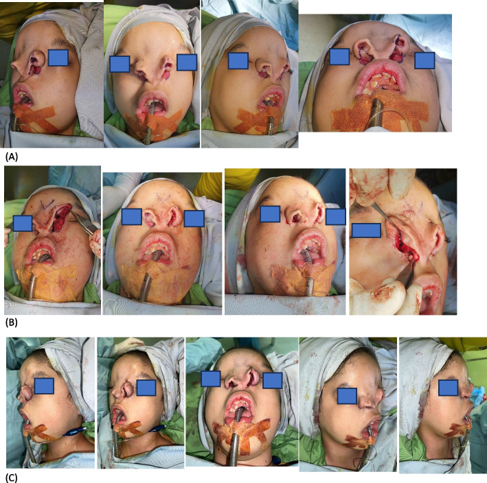 Challenges in nasal reconstruction for facial clefts Tessier 3 bilateral and Tessier 0: a staged surgical approach case report.