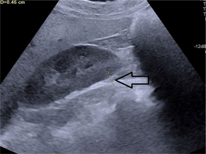 Ultrasonography-based prediction of carotid artery atherosclerosis using multiple abdominal fat indices.